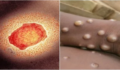 Monkeypox Alert: विश्‍व में मंकीपाक्स के बढ़ते मामलों पर केंद्र सरकार सक्रिय, राज्‍यों के लिए जारी की गाइडलाइन