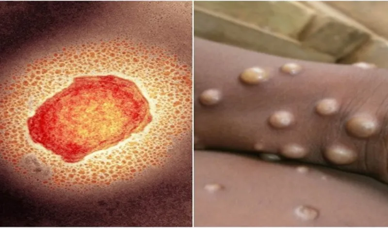 Monkeypox Alert: विश्‍व में मंकीपाक्स के बढ़ते मामलों पर केंद्र सरकार सक्रिय, राज्‍यों के लिए जारी की गाइडलाइन