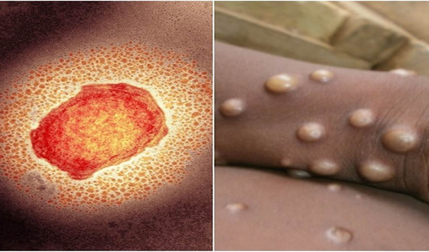 Monkeypox Alert: विश्‍व में मंकीपाक्स के बढ़ते मामलों पर केंद्र सरकार सक्रिय, राज्‍यों के लिए जारी की गाइडलाइन